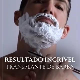 Veja o depoimento que recebemos do nosso paciente 🇺🇸 sobre o resultado do Transplante de Barba del