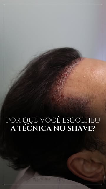 Ele já tinha feito transplante capilar antes e não queria repetir a experiência de esperar 6 meses p