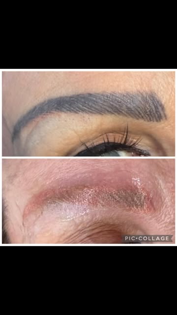 One PicoSure treatment. 🔥

This eyebrow pigment responded beautifully, with significant breakup aft
