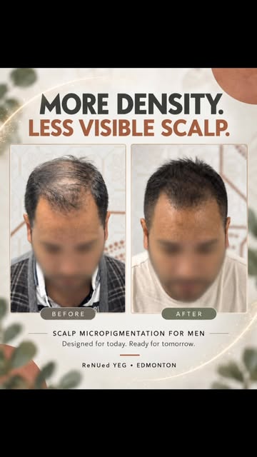 A fuller-looking head of hair—without trying to regrow what has already been lost.

Scalp Micropigme