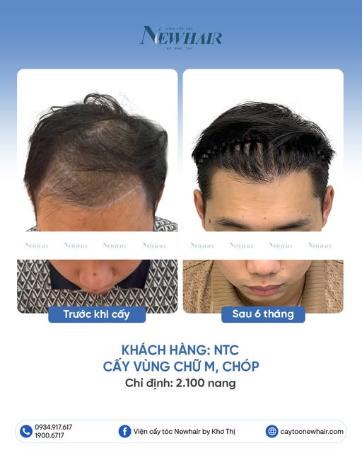 SAU 6 THÁNG, XÓA SẠCH VÙNG HÓI CHO ANH NTC
🔹 Khách hàng: NTC
🔹Cấy tóc vùng chữ M, Hạ line
🔹 Chỉ đ