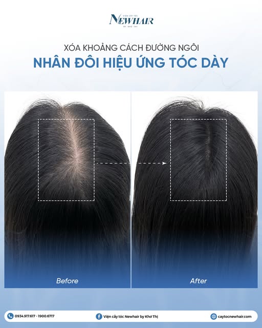 XÓA KHOẢNG CÁCH ĐƯỜNG NGÔI - NHÂN ĐÔI HIỆU ỨNG TÓC DÀY ✨

Đường ngôi tóc chính là "tâm điểm thị giác