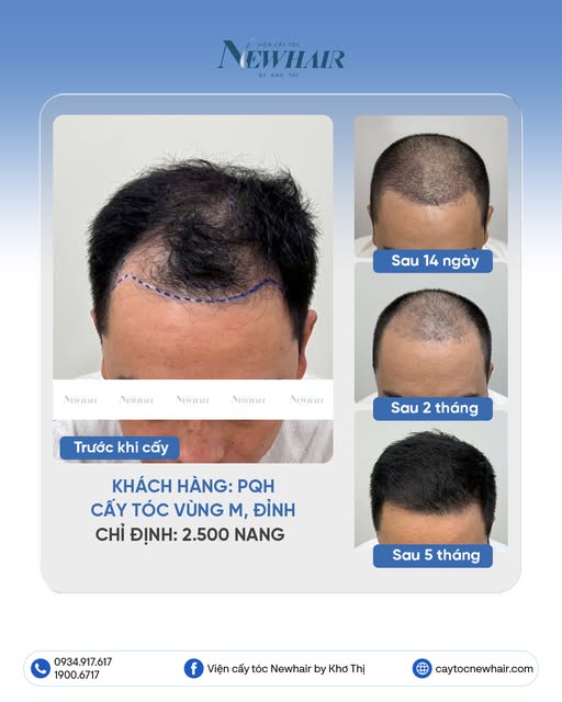 XÓA HÓI THÀNH CÔNG CHO KHÁCH PQH

🔹 Khách hàng: PQH
🔹 Dịch vụ: Cấy tóc vùng chữ M & Vùng đỉnh đầu

