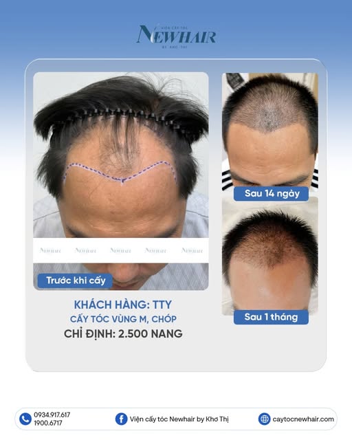 VỪA HÓI CHỮ M VỪA THƯA CHÓP ĐẦU, LÀM THẾ NÀO ĐỂ LẤY LẠI MÁI TÓC TỰ NHIÊN?

🔹 Khách hàng: TTY
🔹 Dịc
