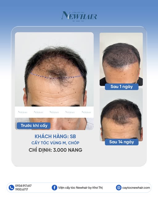 CẤY 3.000 NANG PHỦ KÍN VÙNG CHỮ M CHO KHÁCH NƯỚC NGOÀI 

🔹 Khách hàng: SB 
🔹 Cấy tóc vùng chữ M, c