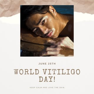 Awareness, Support and Treatment for Vitiligo!  Many treatment options are available for vitiligo;me