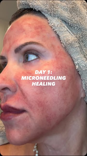 Day 1 of my healing progress after my ZO 3-Step Peel ✨

Today, you can expect the skin to feel dry, 