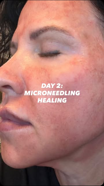 DAY 2: Healing Update

Today my skin is feeling tight, dry, and a little rough, with some mild redne