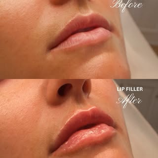 💋 1 mL. Three beautiful results.

Swipe through these lip filler transformations featuring 1 mL of 