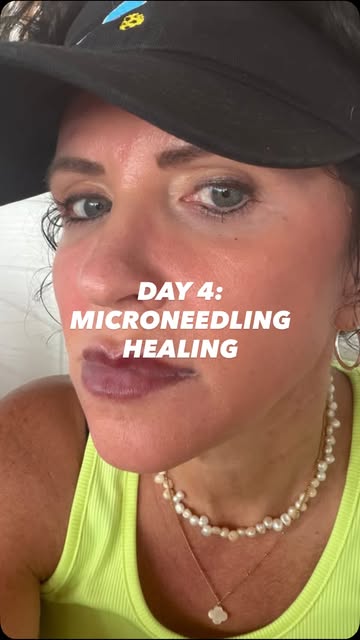 ✨ Day 4: Microneedling + ZO 3-Step Peel ✨

Today I’m seeing more of that dry, peeling skin come away