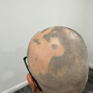 Alopecia is the medical term for hair loss, then there are different types. If a client has Alopecia