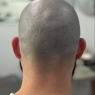 Failed hair transplant left this client feeling down and out, wishing he never went down that path m