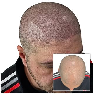 Natural hairlines 🤌🏼

Gain back your confidence with a natural looking hairline, for anyone wantin