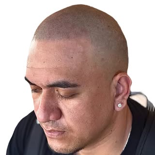 Vmicro Scalp Micropigmentation just hits different 👌

Gain back your confidence 
✅ no surgery or do