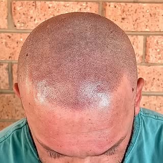 Do you struggle with hair loss? 

You don’t have to anymore I can help you 👊🏼

Gain back your conf
