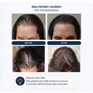 Female hair thinning often shows up as:
• Widening part
• Diffuse thinning
• Receding hairline

Many