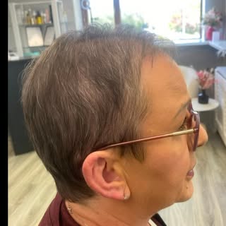 This transformation speaks for itself 🙌

Our lovely client was fitted with her very first SkalpD pi