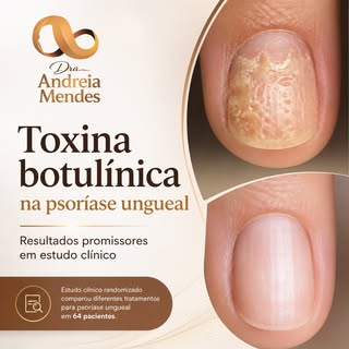 A psoríase ungueal permanece um desafio terapêutico, especialmente em casos refratários.

Um ensaio 