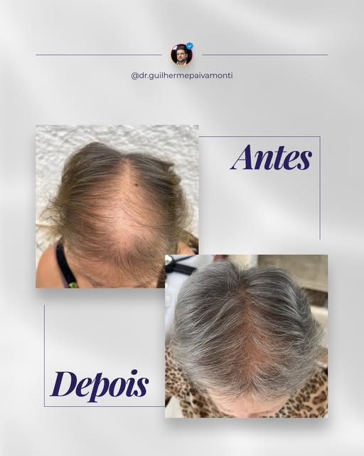 Paciente feminina. Resultado de 12 meses de tratamento. Um resultado que vai muito além da estética.