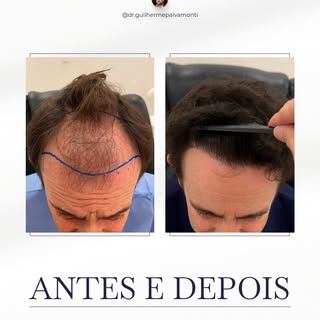 12 meses de evolução. 12 meses após o transplante capilar.

Um transplante capilar bem planejado vai