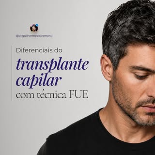 Transplante capilar não é apenas sobre preencher áreas com menos cabelo. É sobre planejamento, natur
