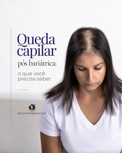 A queda de cabelo após a cirurgia bariátrica é frequente, mas não deve ser simplesmente ignorada.

A