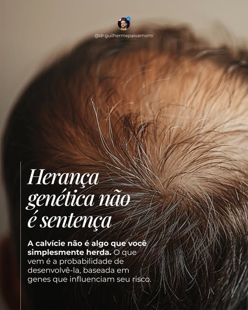 A genética pode aumentar o risco de calvície, mas ela não define sozinha o seu futuro capilar.

A al