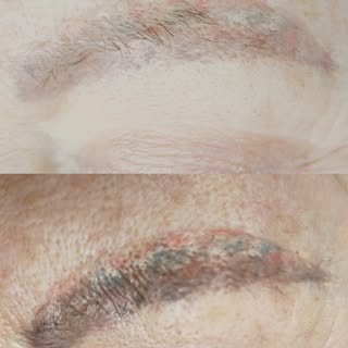 ✨ Narbenkorrektur & Entfernung von altem Permanent Make-up – ein besonders anspruchsvoller Fall ✨
Ma