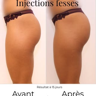 ✨ Un autre angle pour apprécier le résultat.

Voici l'évolution de profil à J14 après des injections
