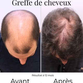 5 000 greffons… mais surtout plusieurs mois de patience avant de découvrir le résultat. 🌱

Une gref
