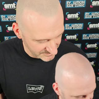 From a Norwood 7 to a full head of hair in just a few hours—what a transformation! 

This client’s j