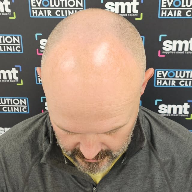 🔥 NORWOOD 6 → THE LOOK OF A FULL HEAD OF HAIR 🔥

What a transformation. 👌

This client came to us