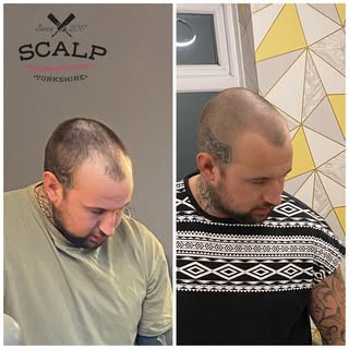 #scalpmicropigmentation #smp #smpyorkshire #scalp #bald #malepatternbaldness #hairloss #hairline #ha