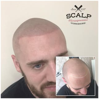 #scalp #scalpmicropigmentation
