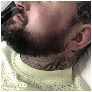 Swipe for before 👉🏼
#smp #scalpmicropigmentation #scalp #malebaldnesspattern #smpyorkshire #beard 