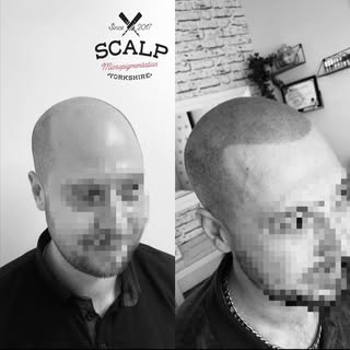 Transformation 🙌🏼 3 sessions! 
#scalpmicropigmentation #scalp #smp #smpyorkshire #hair #head #hair