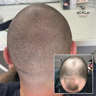 #scalp #smp #smpyorkshire #scalpmicropigmentation #hairlosstreatment #hairlosssolution