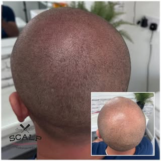 #smp #scalpmicropigmentation #beforeandafter #hairtransformation #hairlinetattoo #hairlosssolution #