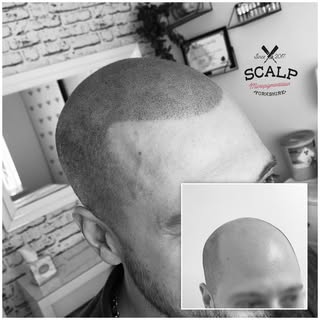 Pow pow 💥 

#scalp #scalpmicropigmentation #smp #hairloss #hairlosssolution #hairlosstreatment #hai