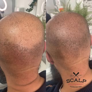 #scalp #scalpmicropigmentation #hairline #hairlinetattoo #scalp