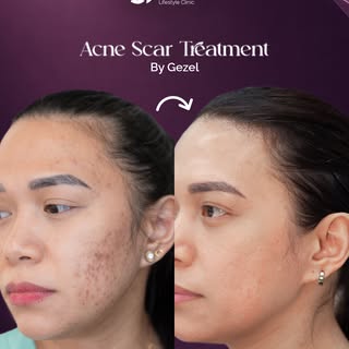 Acne scars don’t have to define your skin. 🤍With the right treatment plan tailored to your skin, we