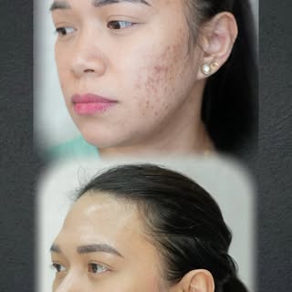 ⁨	خطوة واحدة لبشرة أكثر صفاء ✨❤️ Scar removal by Gezel
#ScarRevision
#ScarRemoval
#SkinRejuvenation
