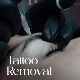 No words needed. The results say it all✨  Tatto removal by Gezel  #tattoremoval #clearskin #before #