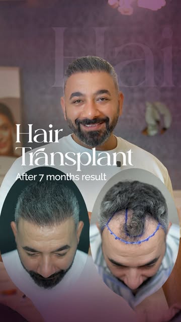 ⁨	8 شهور فقط… والنتيجة تتكلم عن نفسها 

كثافة، امتلاء، وخط شعر طبيعي بشكل واضح 👌🏻

بدك تعرف إذا مم