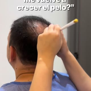 El implante capilar es un proceso, no te dejes engañar! Toma tiempo, entre 8 meses y un año para ver