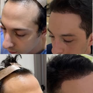 Hoy nuestro paciente Nicolas nos cuenta sobre su procedimiento de implante capilar después de 7 mese