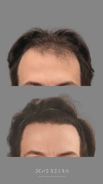 Um resultado construído com planejamento, naturalidade e uma boa área doadora.

Neste caso, realizam
