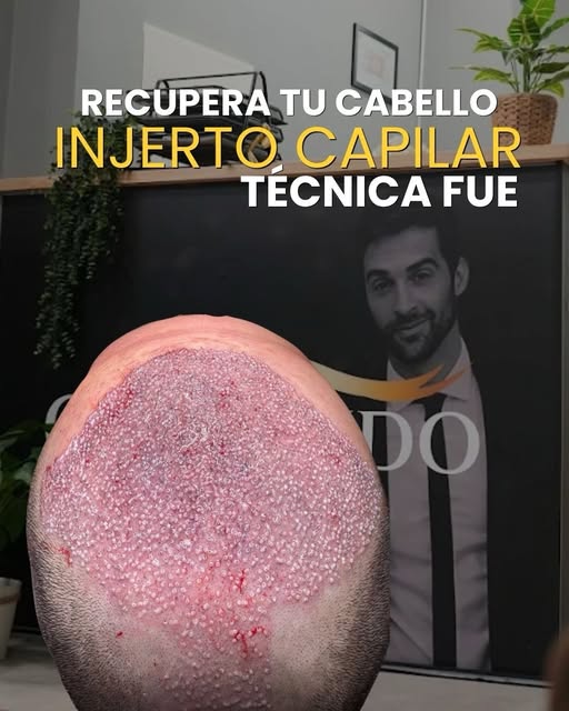 Recupera tu cabello y tu confianza de forma definitiva. 👨‍⚕️

La técnica FUE de injerto capilar nos