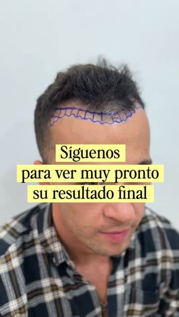 Un buen injerto capilar comienza con un diseño pensado para cada rostro. ✍🏻

Hoy empieza el proceso