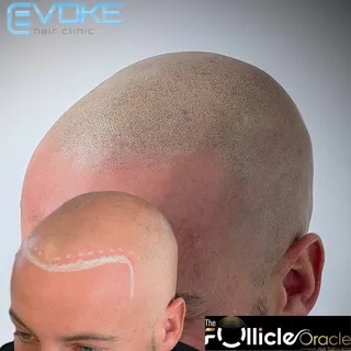 Bald to bold, Prince to king 🤴. Hairline & confidence restored with SMP 🤩.

Find out how we can he